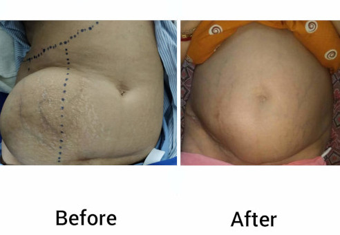 01 hernia-before-after